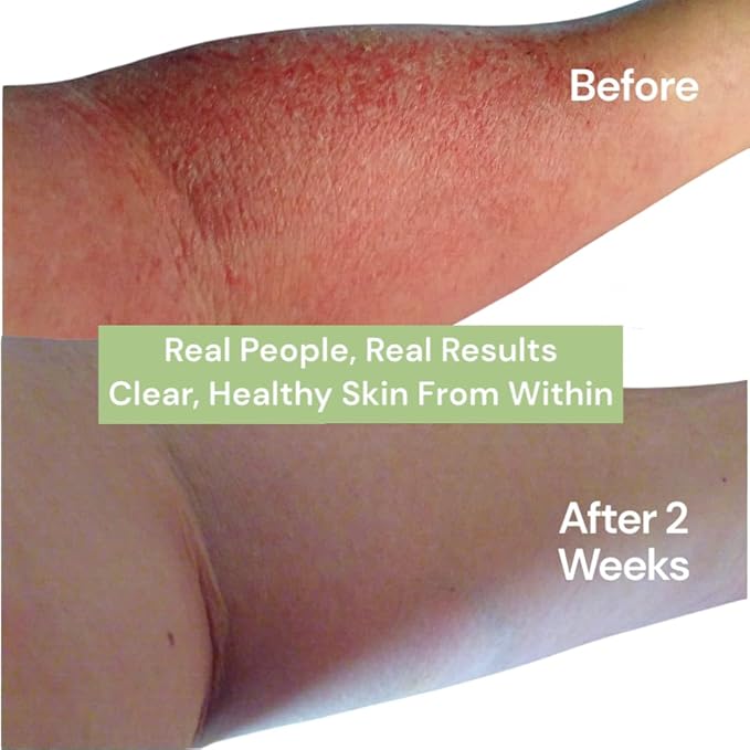 Eczema Pills – Natural Eczema Treatment – Dermatologist Developed, 7 All Natural Minerals Clear & Prevent Eczema Scaling, Rash, Itch, Inflamed Skin - Suitable for Kids & Adults